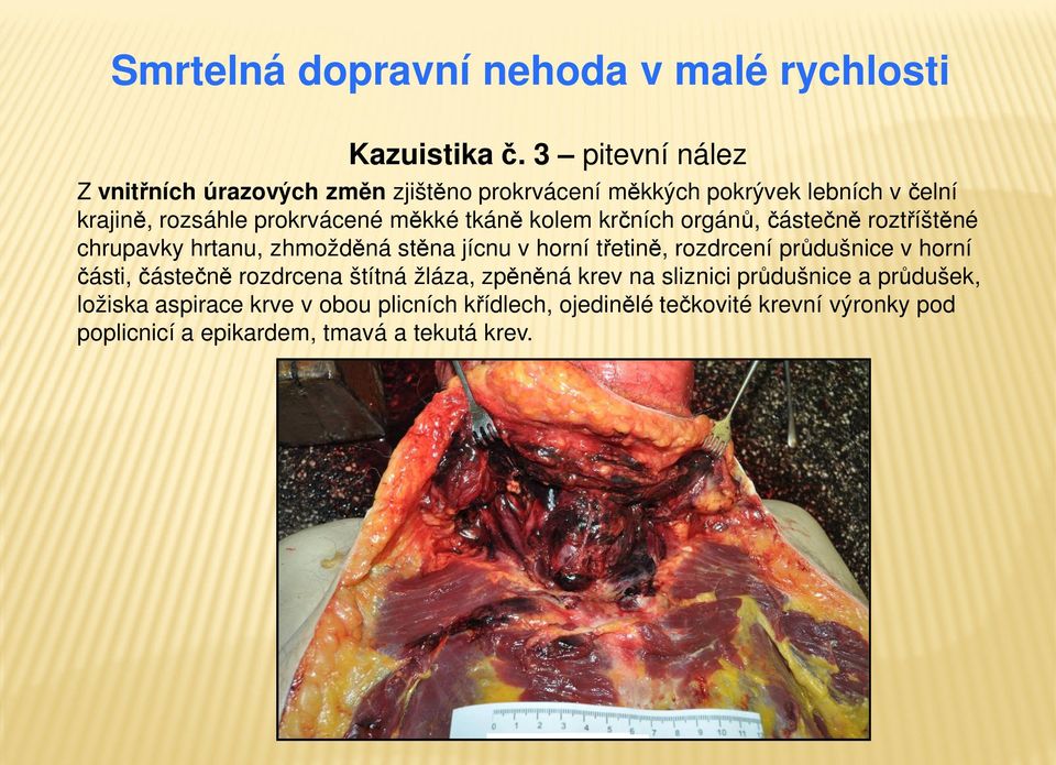 tkáně kolem krčních orgánů, částečně roztříštěné chrupavky hrtanu, zhmožděná stěna jícnu v horní třetině, rozdrcení průdušnice v horní