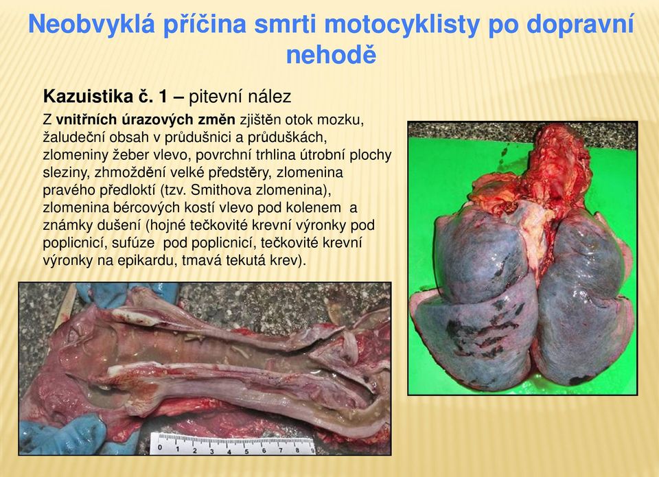 vlevo, povrchní trhlina útrobní plochy sleziny, zhmoždění velké předstěry, zlomenina pravého předloktí (tzv.