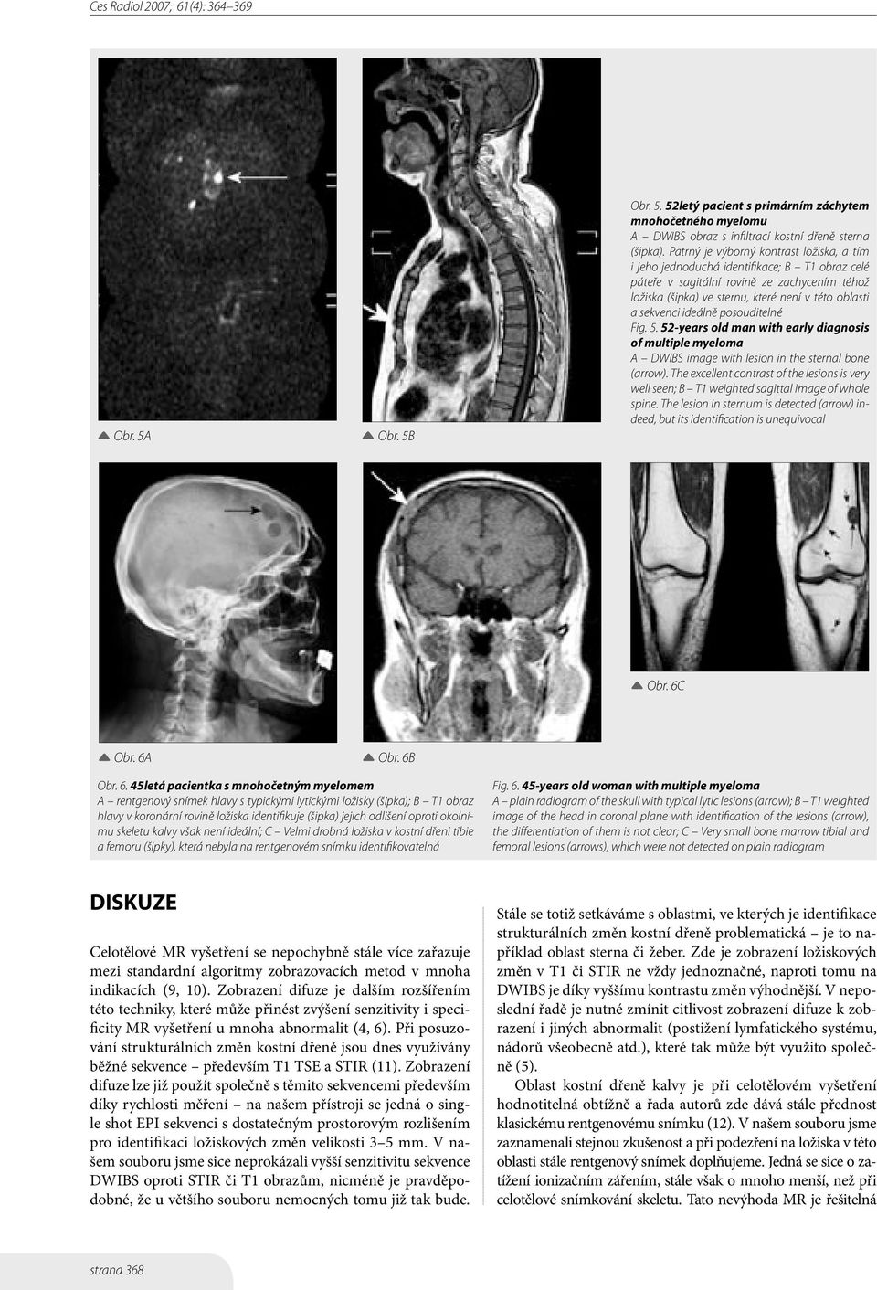 ideálně posouditelné Fig. 5. 52-years old man with early diagnosis of multiple myeloma A DWIBS image with lesion in the sternal bone (arrow).