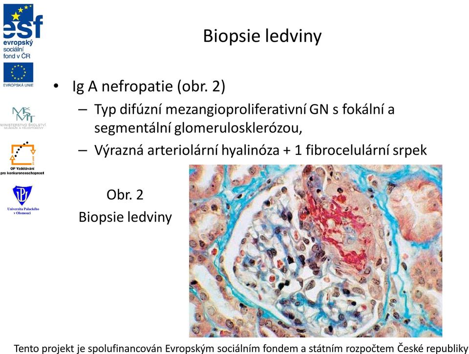 a segmentální glomerulosklerózou, Výrazná