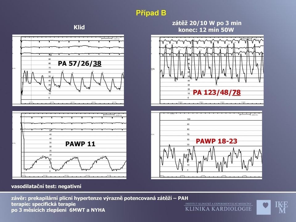 negativní závěr: prekapilární plicní hypertenze výrazně