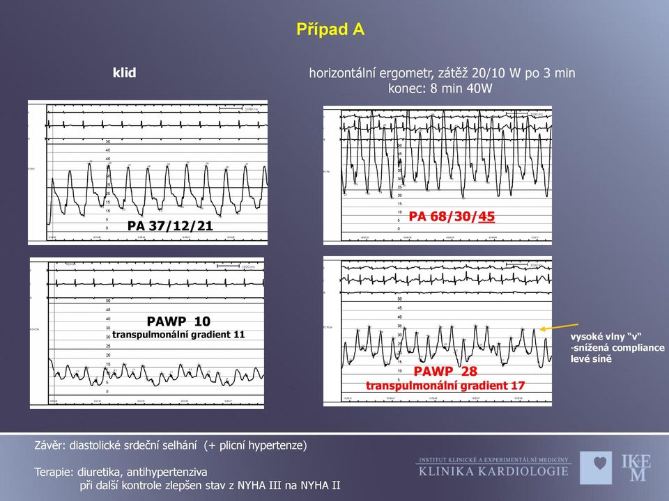 vlny v -snížená compliance levé síně Závěr: diastolické srdeční selhání (+ plicní