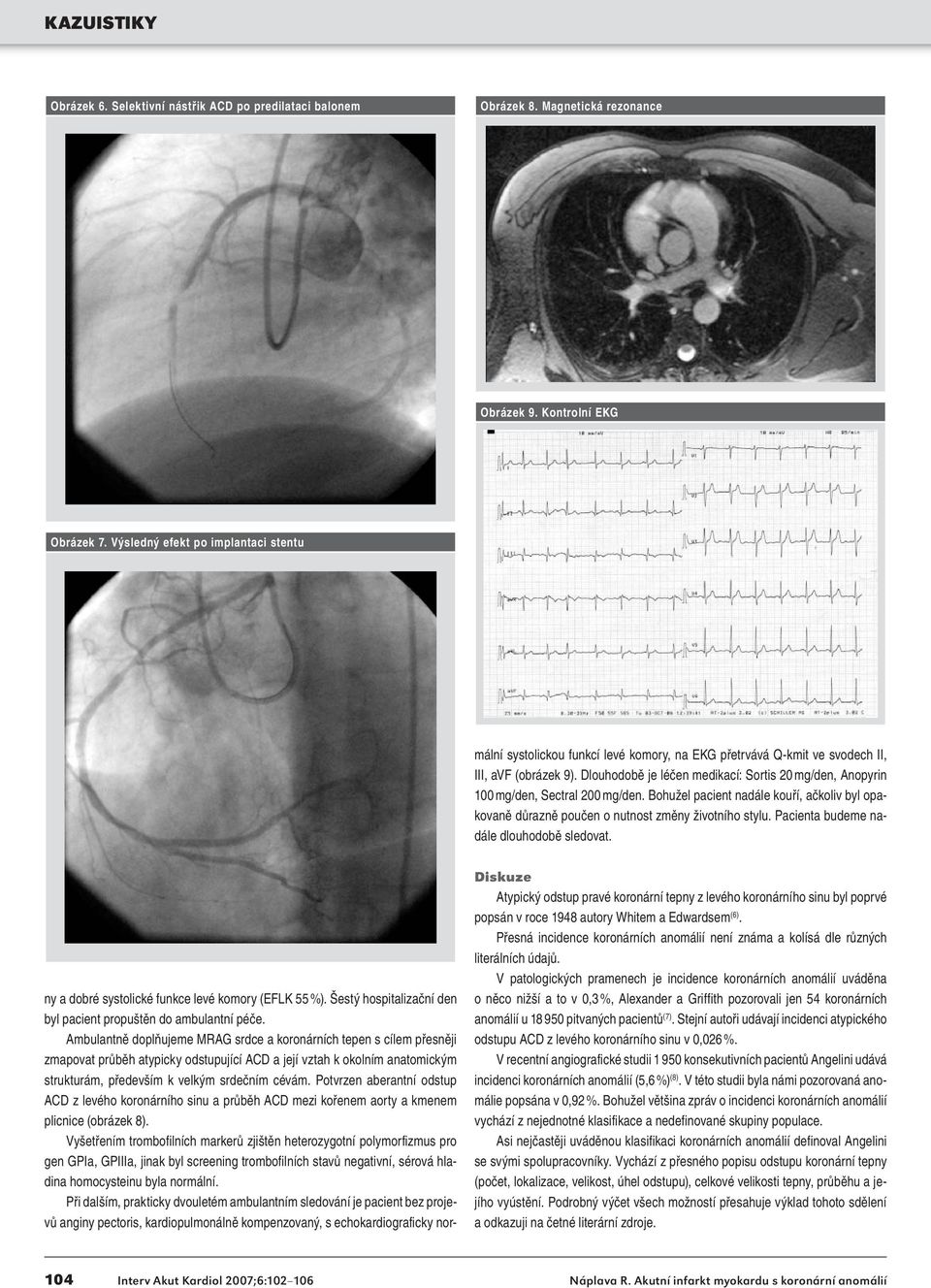 Ambulantně doplňujeme MRAG srdce a koronárních tepen s cílem přesněji zmapovat průběh atypicky odstupující ACD a její vztah k okolním anatomickým strukturám, především k velkým srdečním cévám.