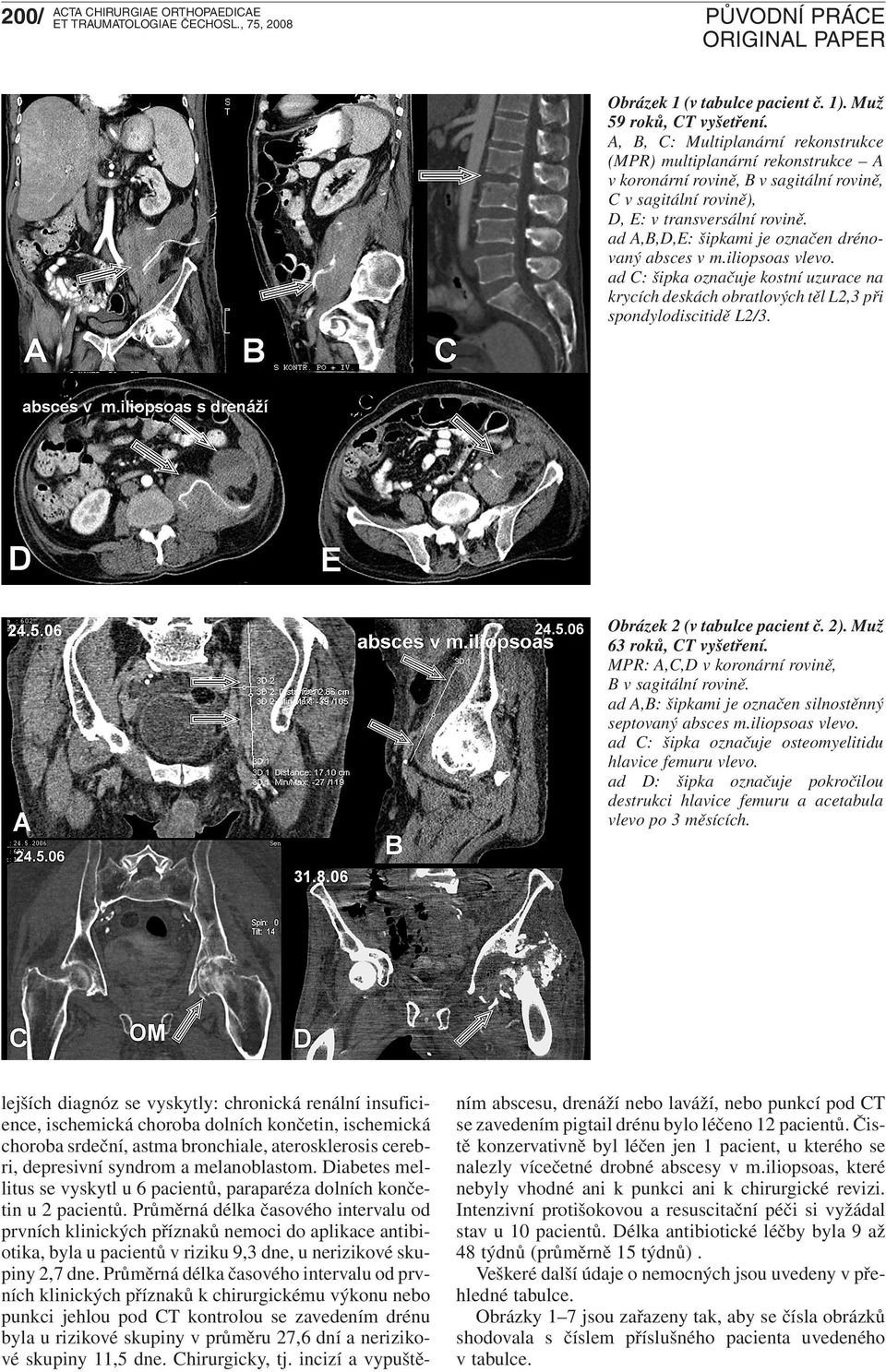 ad A,B,D,E: šipkami je označen drénovaný absces v m.iliopsoas vlevo. ad C: šipka označuje kostní uzurace na krycích deskách obratlových těl L2,3 při spondylodiscitidě L2/3.