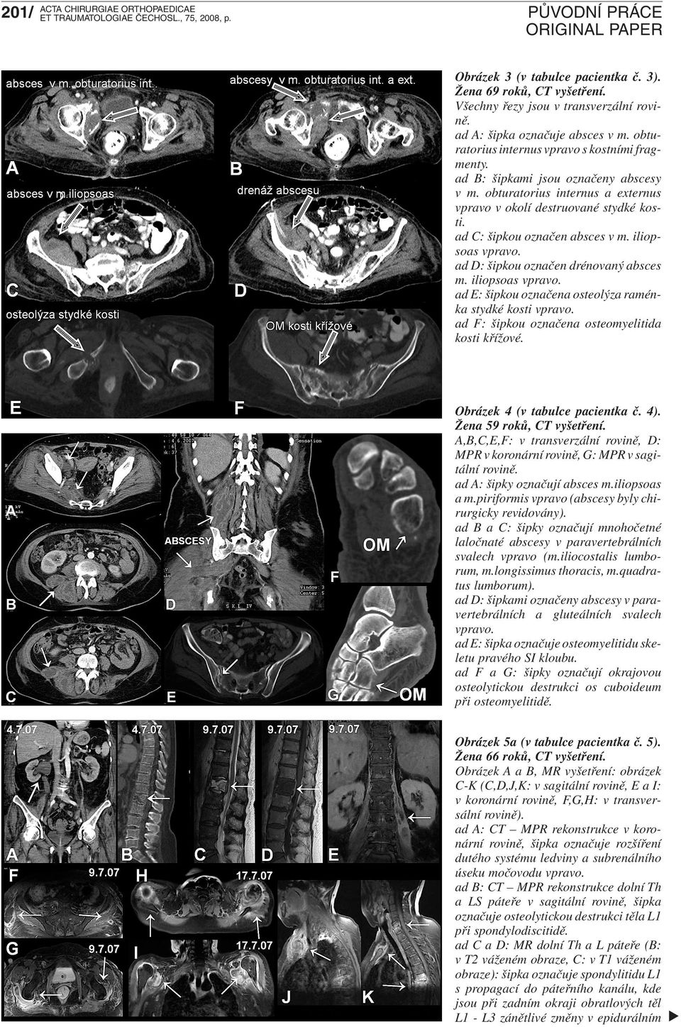 iliopsoas vpravo. ad D: šipkou označen drénovaný absces m. iliopsoas vpravo. ad E: šipkou označena osteolýza raménka stydké kosti vpravo. ad F: šipkou označena osteomyelitida kosti křížové.