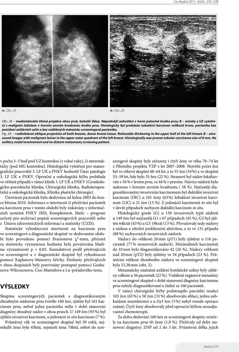 Histologicky byl prokázán tubulární karcinom velikosti 8 mm, pacientka bez postižení axilárních uzlin a bez vzdálených metastáz; screeningová pacientka. Fig.