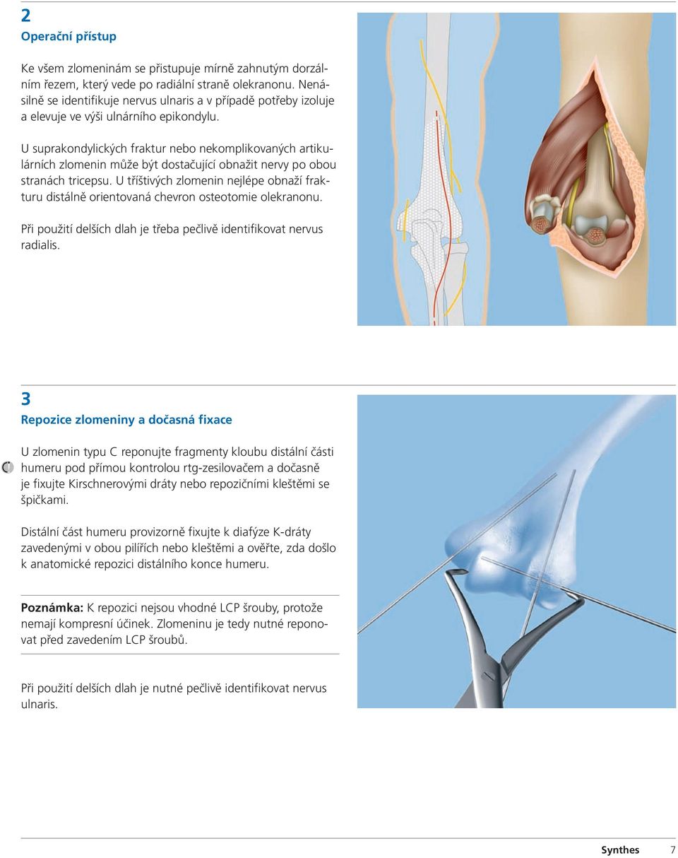 U suprakondylických fraktur nebo nekomplikovaných artikulárních zlomenin může být dostačující obnažit nervy po obou stranách tricepsu.