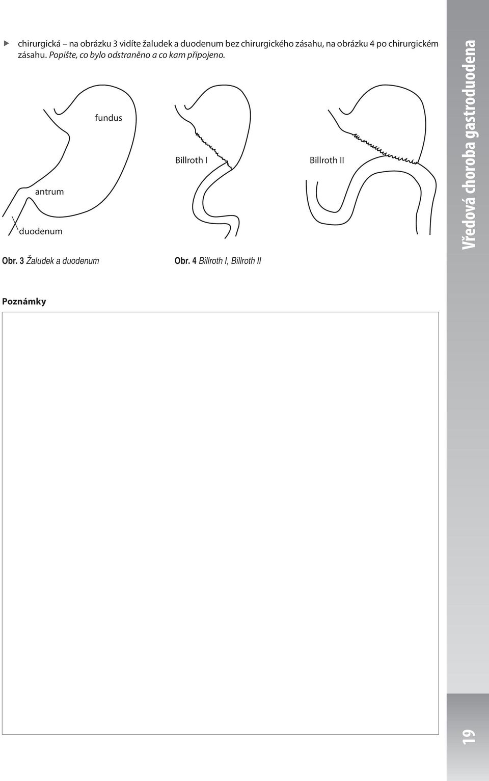 Popište, co bylo odstraněno a co kam připojeno. antrum duodenum Obr.