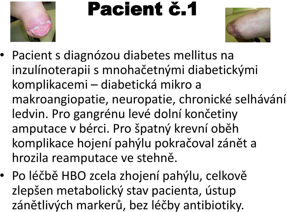 mikro a makroangiopatie, neuropatie, chronické selhávání ledvin. Pro gangrénu levé dolní končetiny amputace v bérci.