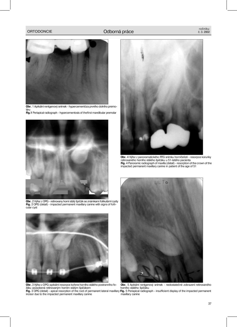 4 Výřez z panoramatického RTG snímku horníčelisti - resorpce korunky retinovaného horního stálého špičáku u 51-letého pacienta Fig.