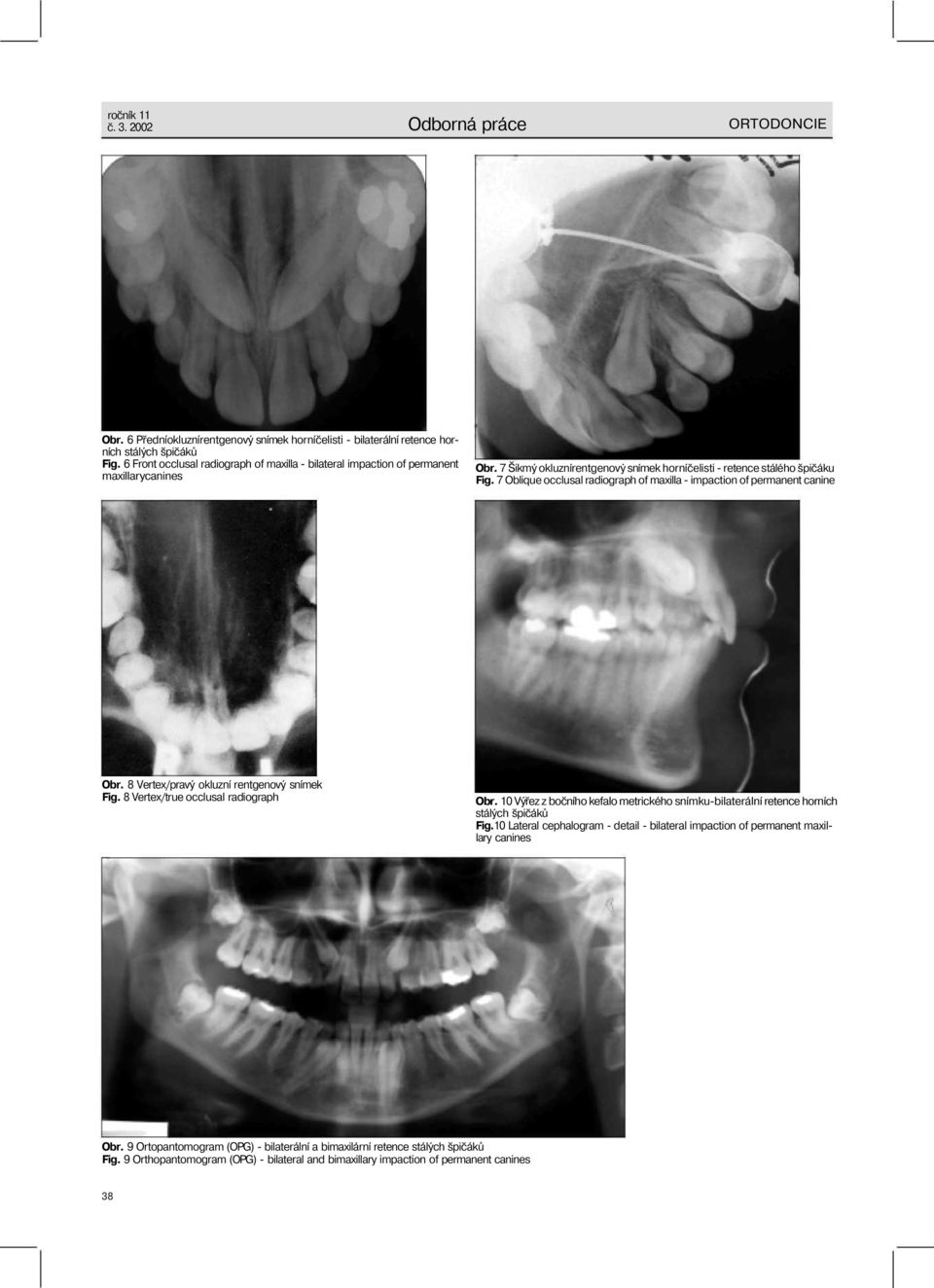 7 Oblique occlusal radiograph of maxilla - impaction of permanent canine Obr. 8 Vertex/pravý okluzní rentgenový snímek Fig. 8 Vertex/true occlusal radiograph Obr.