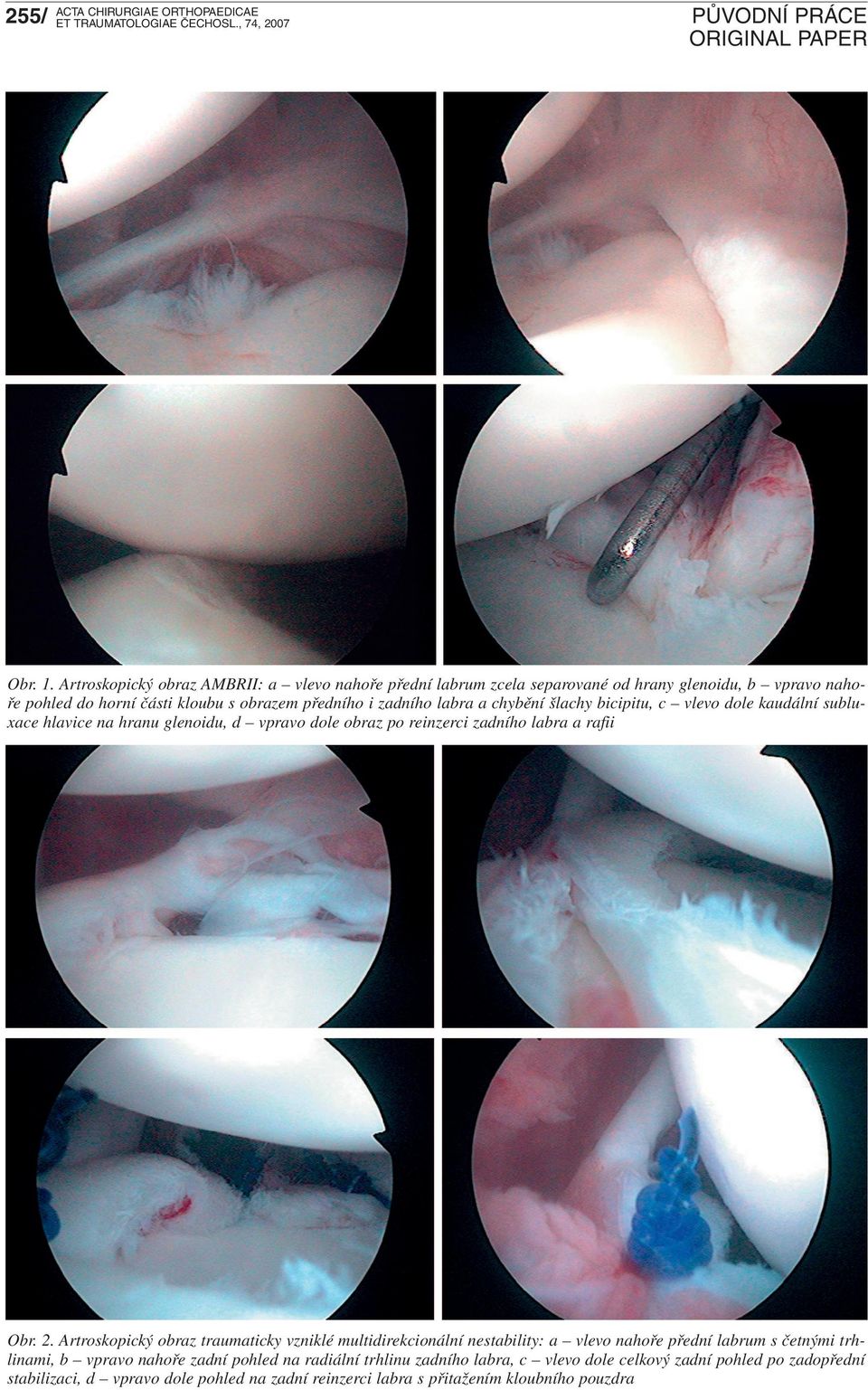 Artroskopický obraz AMBRII: a vlevo nahoře přední labrum zcela separované od hrany glenoidu, b vpravo nahoře pohled do horní části kloubu s obrazem předního i zadního labra
