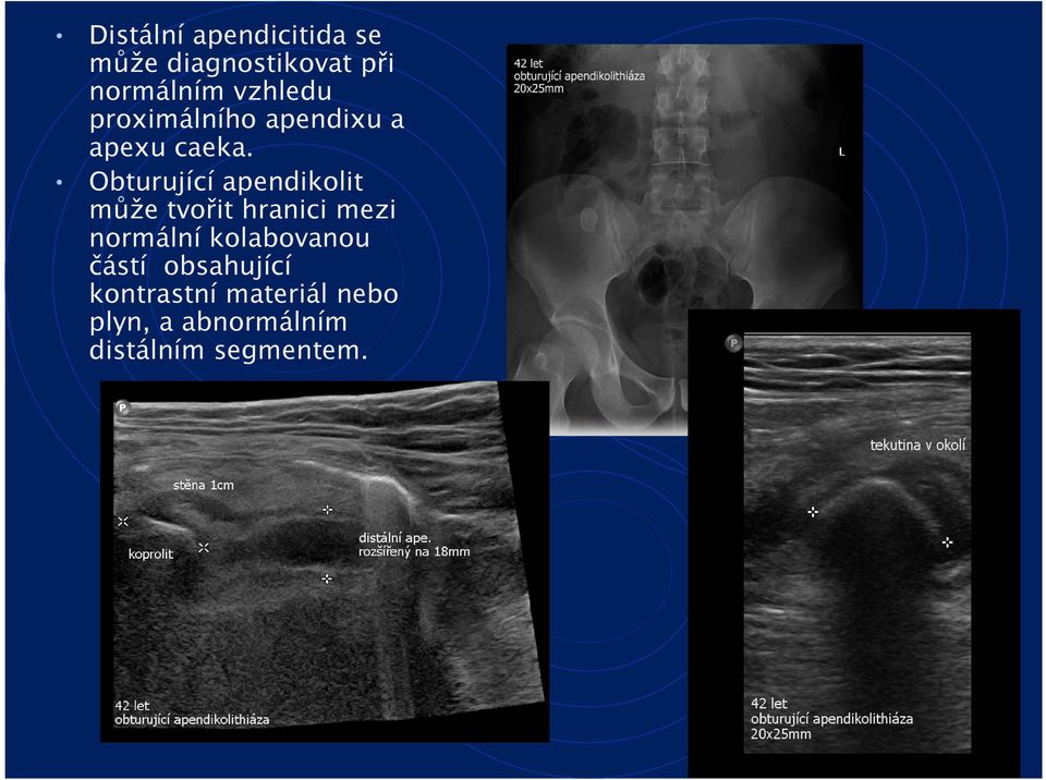 Obturující apendikolit může tvořit hranici mezi normální
