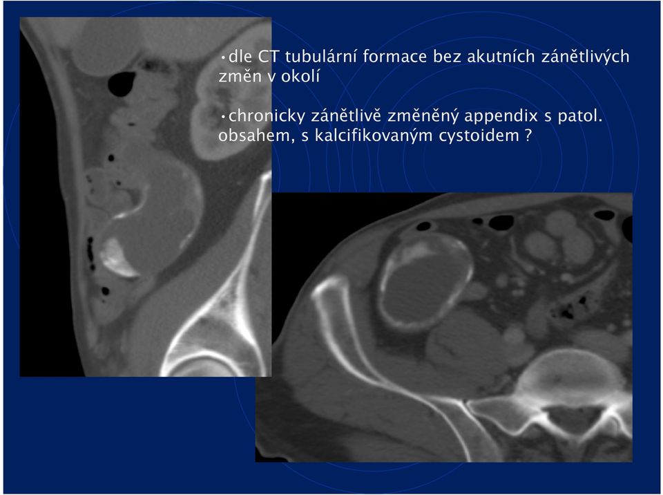 chronicky zánětlivě změněný appendix