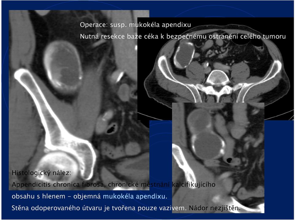 tumoru Histologický nález: Appendicitis chronica fibrosa, chronické