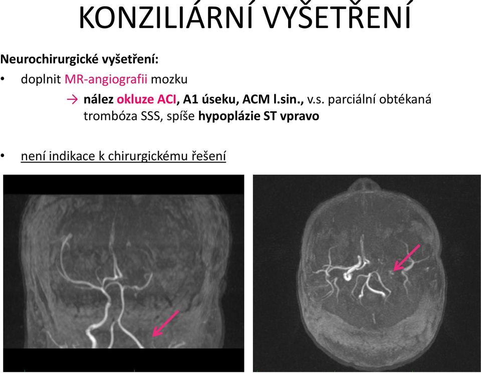 úseku, ACM l.sin., v.s. parciální obtékaná trombóza