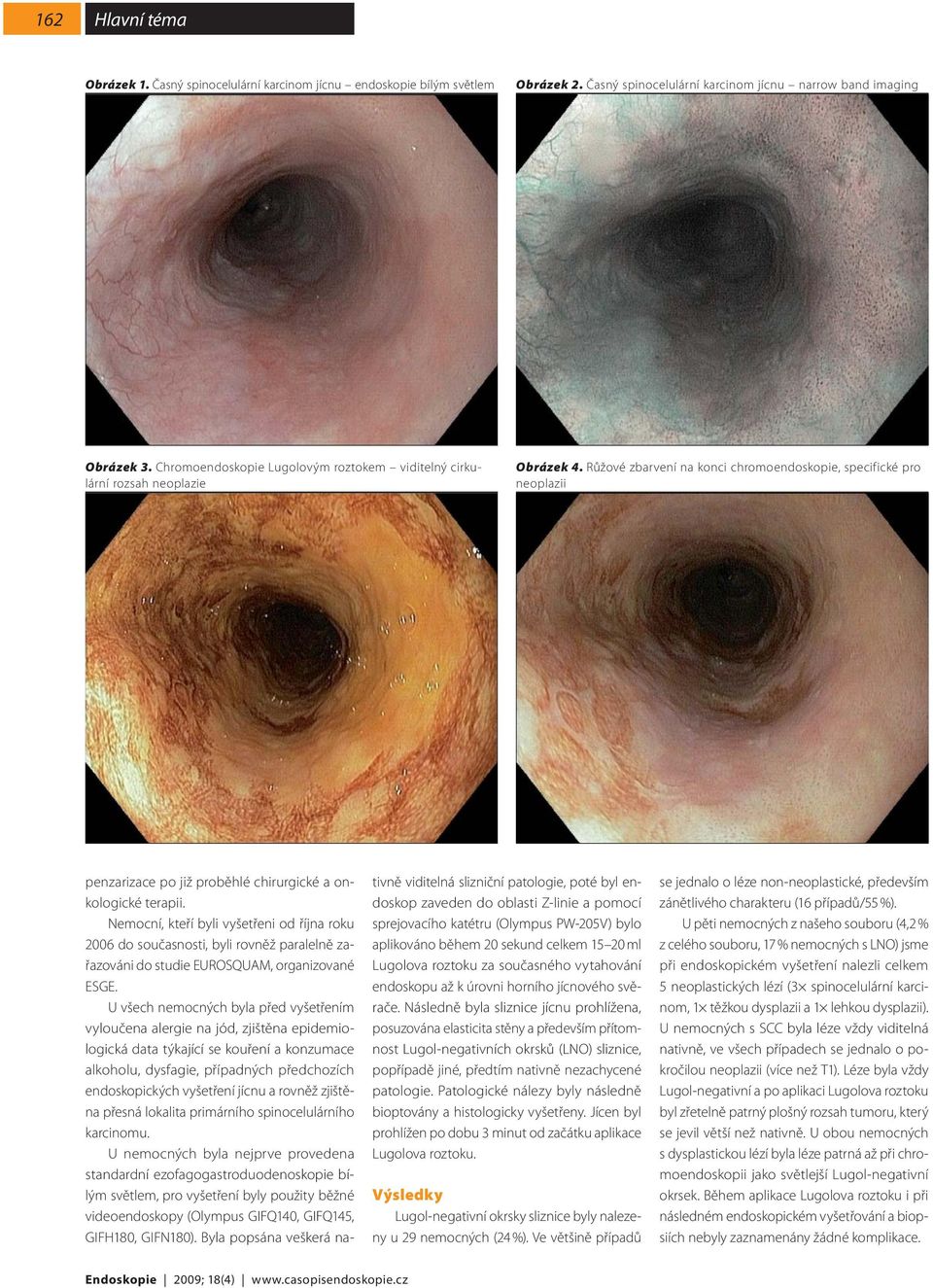 Růžové zbarvení na konci chromoendoskopie, specifické pro neoplazii penzarizace po již proběhlé chirurgické a onkologické terapii.