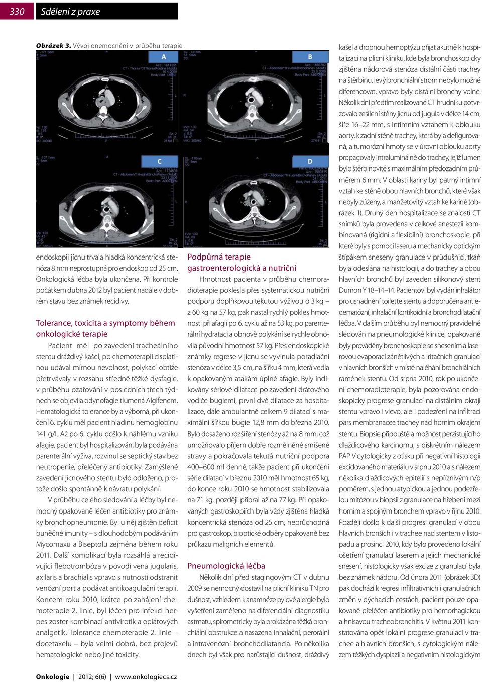 Tolerance, toxicita a symptomy během onkologické terapie Pacient měl po zavedení tracheálního stentu dráždivý kašel, po chemoterapii cisplatinou udával mírnou nevolnost, polykací obtíže přetrvávaly v