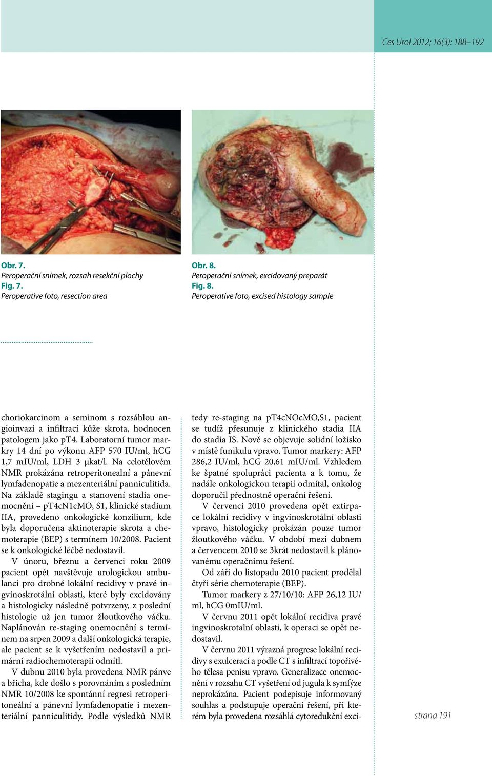 Laboratorní tumor markry 14 dní po výkonu AFP 570 IU/ml, hcg 1,7 miu/ml, LDH 3 µkat/l. Na celotělovém NMR prokázána retroperitonealní a pánevní lymfadenopatie a mezenteriální panniculitida.