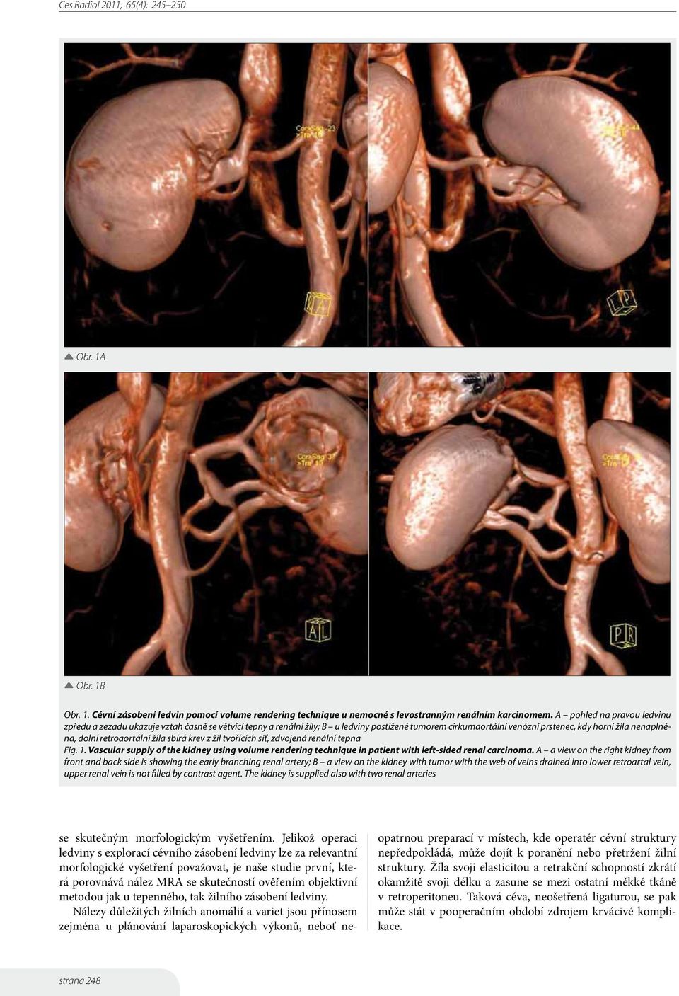 retroaortální žíla sbírá krev z žil tvořících síť, zdvojená renální tepna Fig. 1. Vascular supply of the kidney using volume rendering technique in patient with left-sided renal carcinoma.