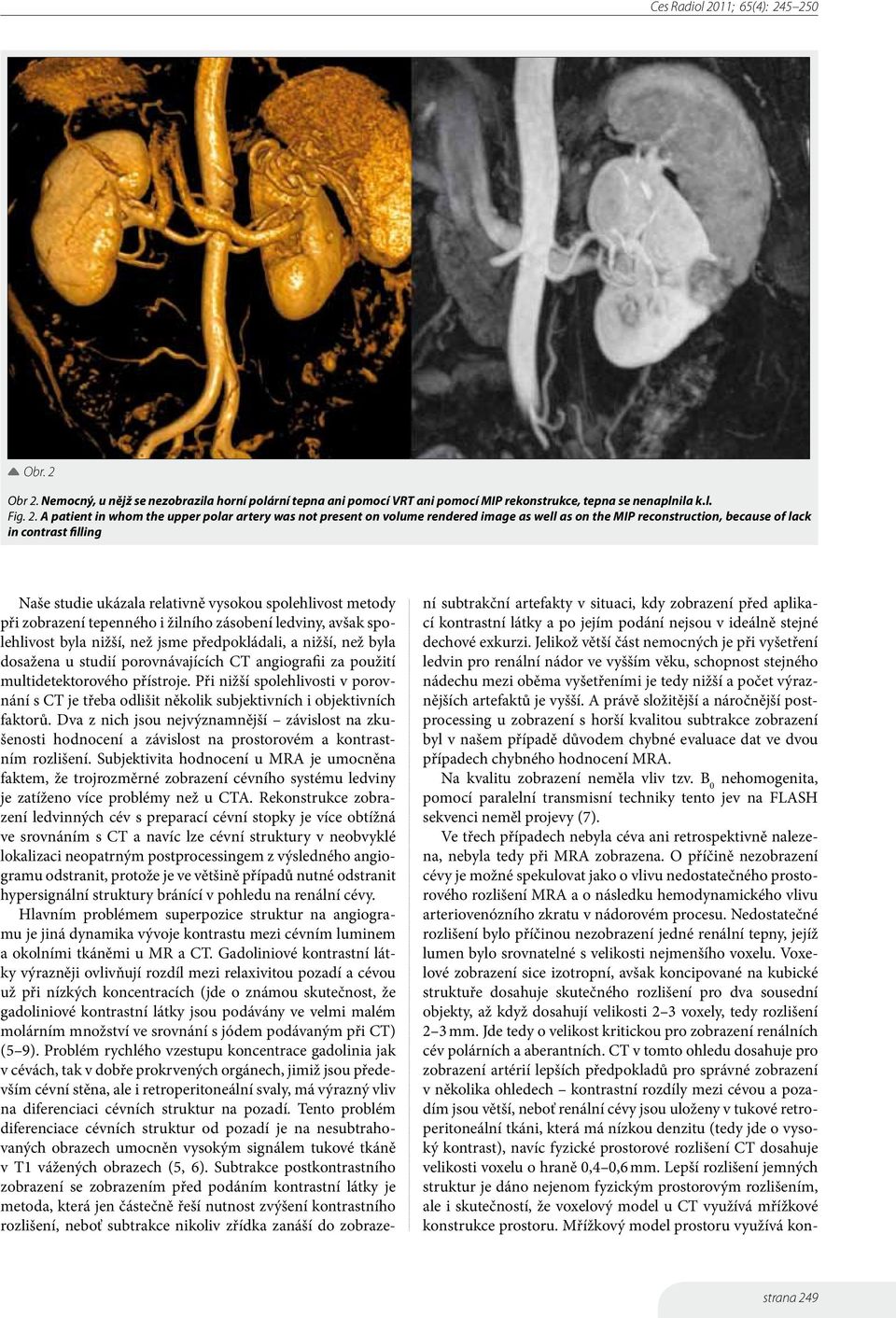 Nemocný, u nějž se nezobrazila horní polární tepna ani pomocí VRT ani pomocí MIP rekonstrukce, tepna se nenaplnila k.l. Fig. 2.