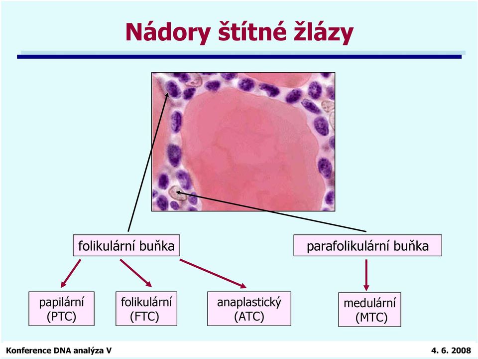 papilární (PTC) folikulární