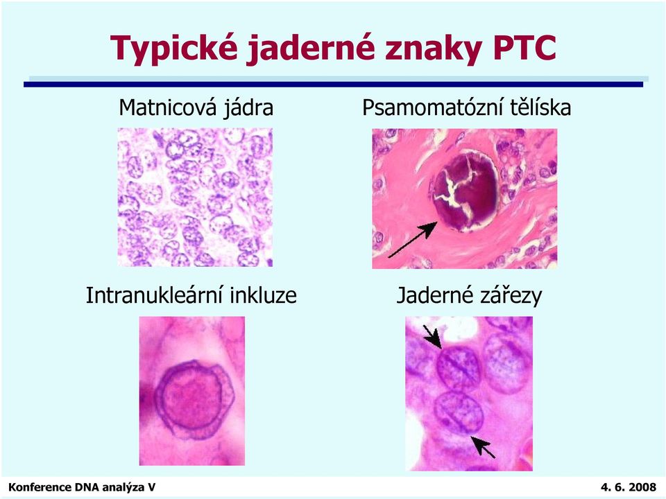 Psamomatózní tělíska