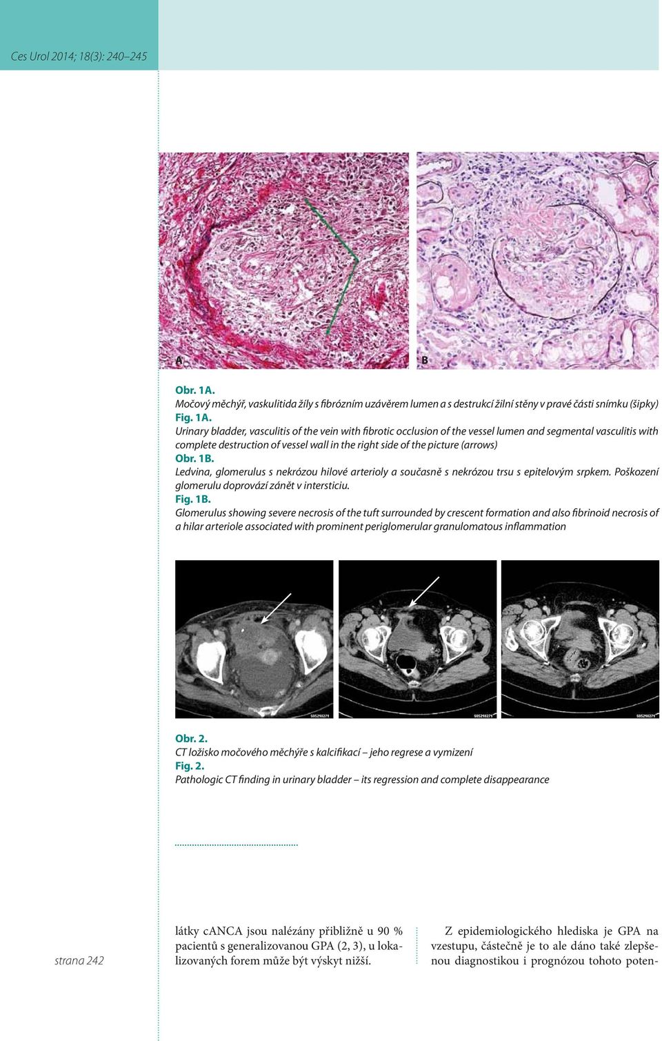 Urinary bladder, vasculitis of the vein with fibrotic occlusion of the vessel lumen and segmental vasculitis with complete destruction of vessel wall in the right side of the picture (arrows) Obr. 1B.