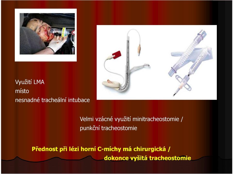 punkční tracheostomie Přednost při lézi horní