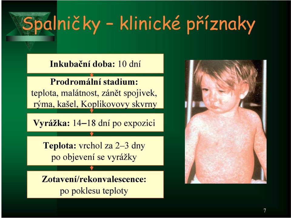 Koplikovovy skvrny Vyrážka: 14 18 dní po expozici Teplota: vrchol