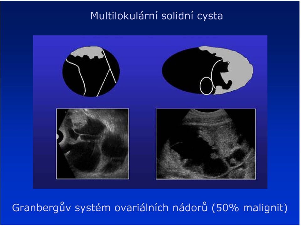 Granbergův systém