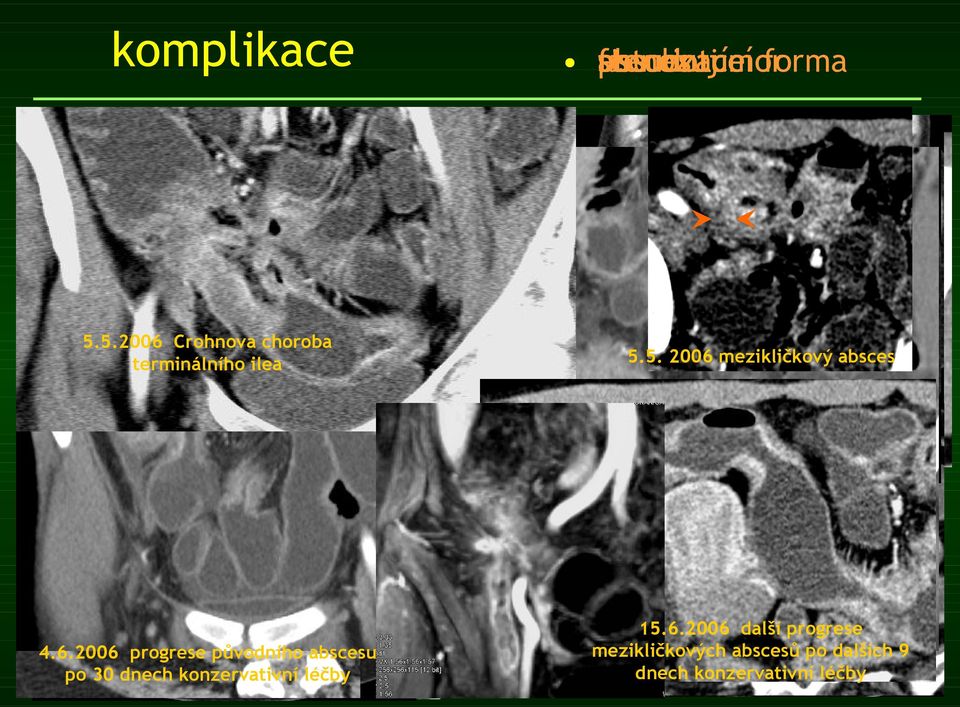 2006 progrese původního abscesu po 30 dnech konzervativní léčby absces