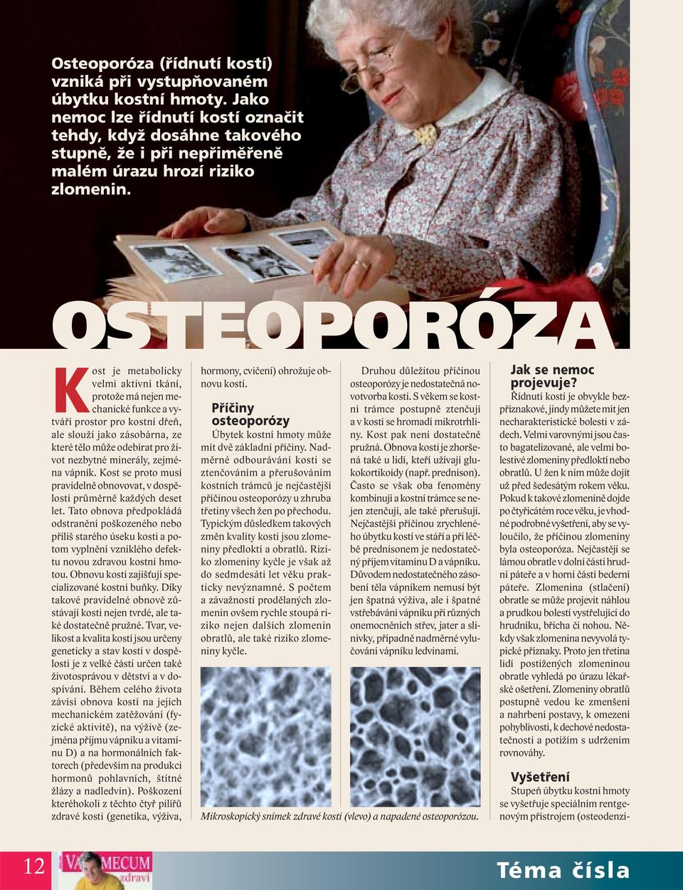 OSTEOPORÓZA Kost je metabolicky velmi aktivní tkání, protože má nejen mechanické funkce a vytváří prostor pro kostní dřeň, ale slouží jako zásobárna, ze které tělo může odebírat pro život nezbytné