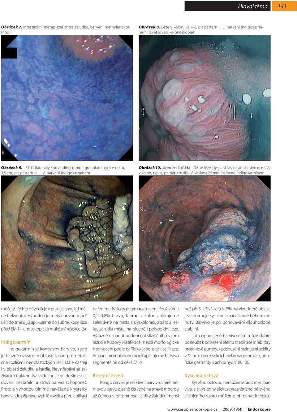Ulcerozní kolitida DALM léze (dysplasia associated lesion or mass) v kolon, typ Is, pit pattern IIIs IV, velikost 25 mm, barveno indigokarmínem moče.