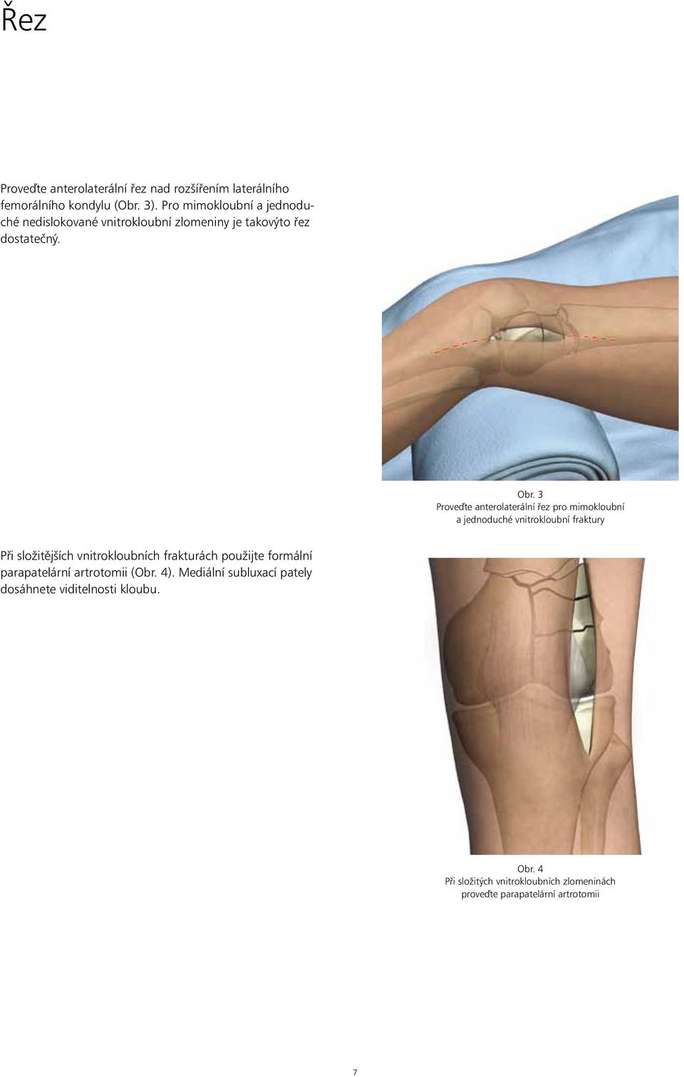 3 Proveďte anterolaterální řez pro mimokloubní a jednoduché vnitrokloubní fraktury Při složitějších vnitrokloubních frakturách