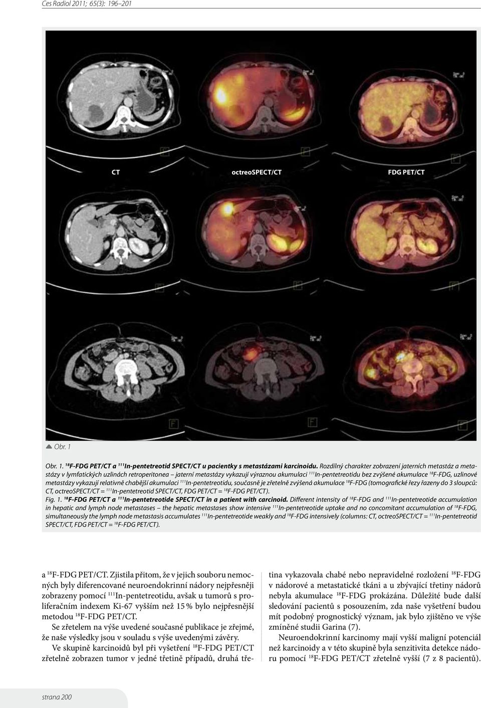 uzlinové metastázy vykazují relativně chabější akumulaci 111 In-pentetreotidu, současně je zřetelně zvýšená akumulace F-FDG (tomografické řezy řazeny do 3 sloupců: CT, octreospect/ct = 111