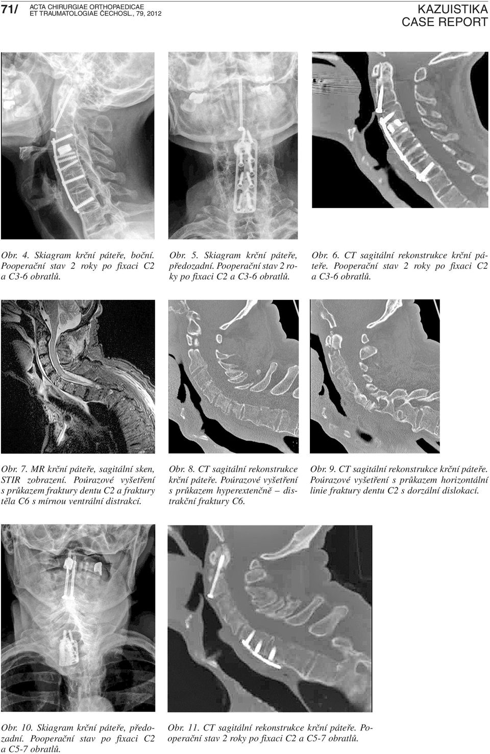 Poúrazové vyšetření s průkazem fraktury dentu C2 a fraktury těla C6 s mírnou ventrální distrakcí. Obr. 8. CT sagitální rekonstrukce krční páteře.