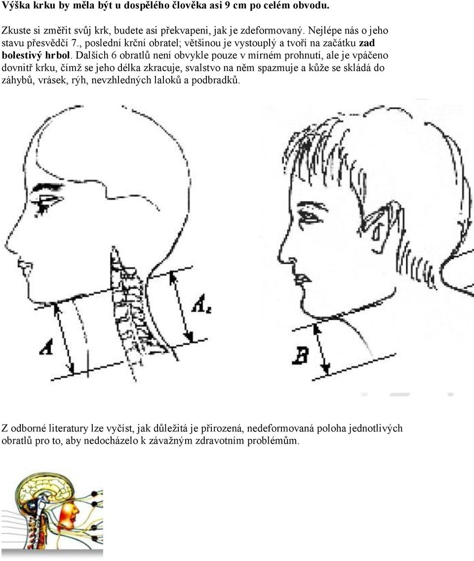 Dalších 6 obratlů není obvykle pouze v mírném prohnutí, ale je vpáčeno dovnitř krku, čímž se jeho délka zkracuje, svalstvo na něm spazmuje a kůže se skládá do