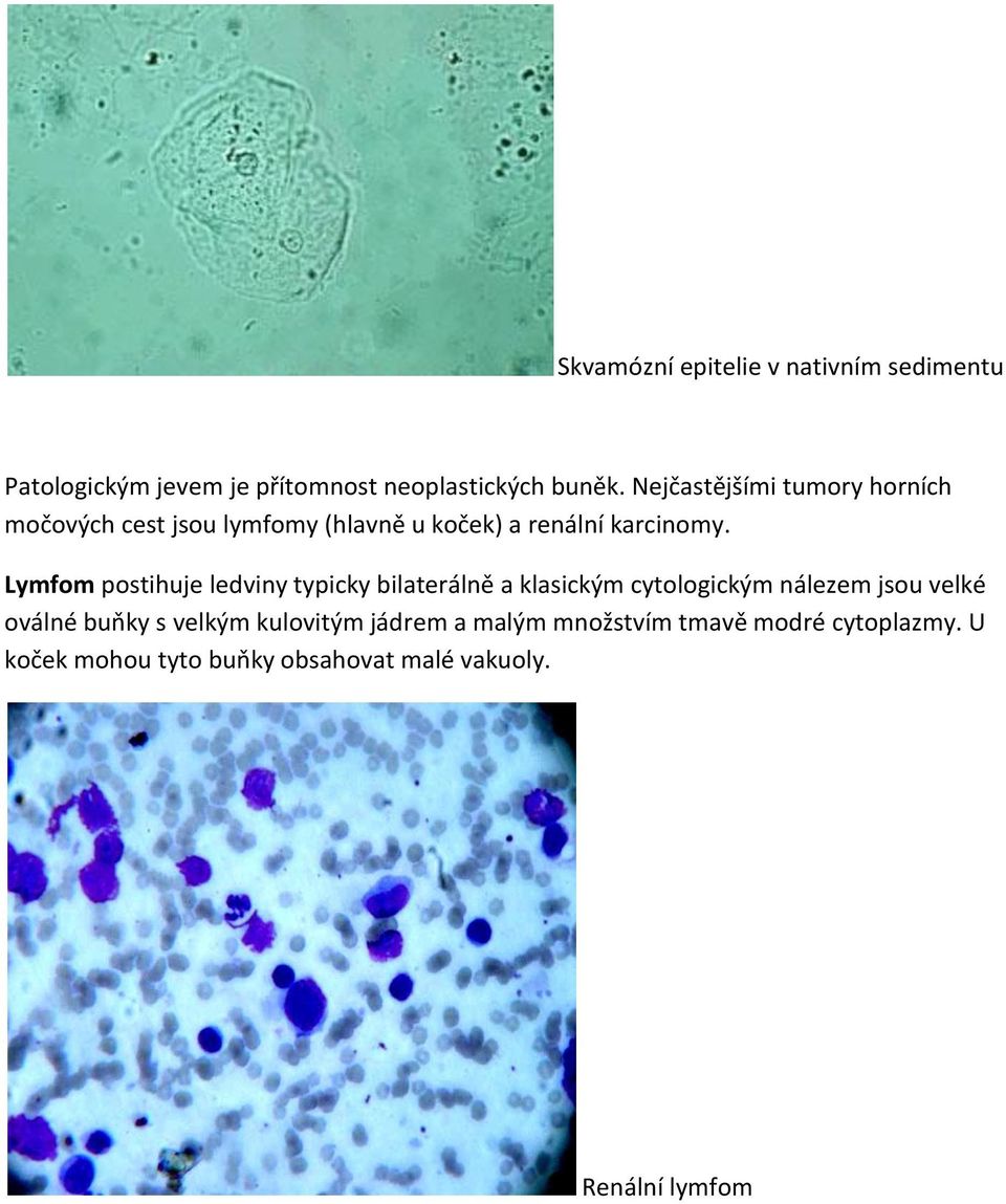 Lymfom postihuje ledviny typicky bilaterálně a klasickým cytologickým nálezem jsou velké oválné buňky s