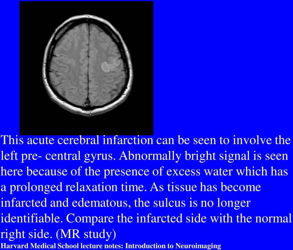 relaxation time. As tissue has become infarcted and edematous, the sulcus is no longer identifiable.