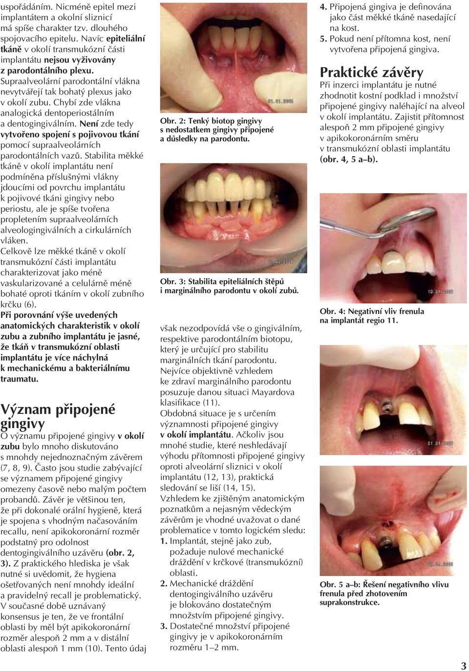 Chybí zde vlákna analogická dentoperiostálním a dentogingiválním. Není zde tedy vytvořeno spojení s pojivovou tkání pomocí supraalveolárních parodontálních vazů.
