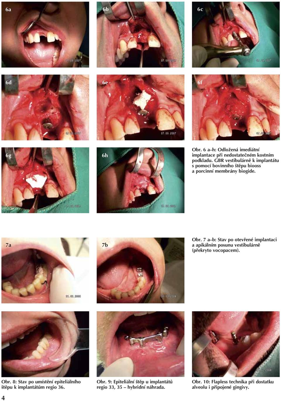 7 a b: Stav po otevřené implantaci a apikálním posunu vestibulárně (překryto vocopacem). Obr.