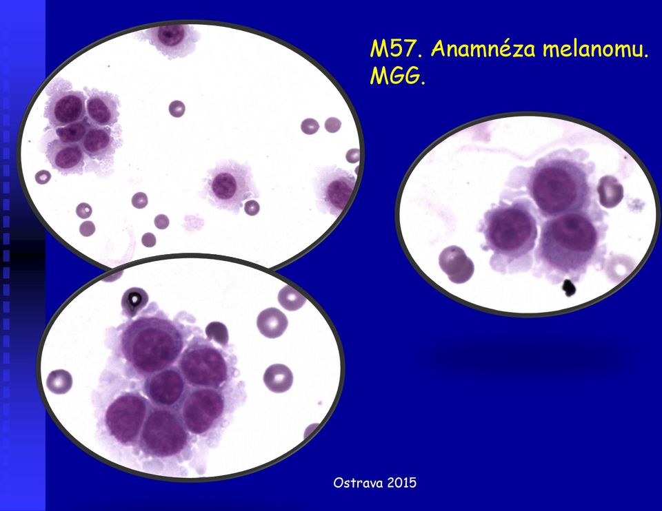 melanomu.