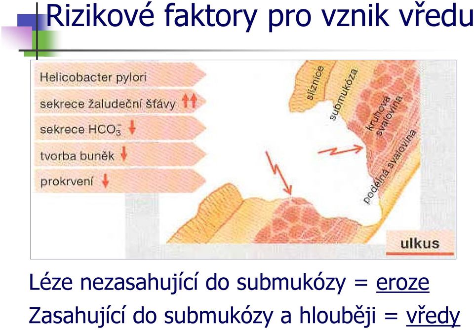 submukózy = eroze Zasahující