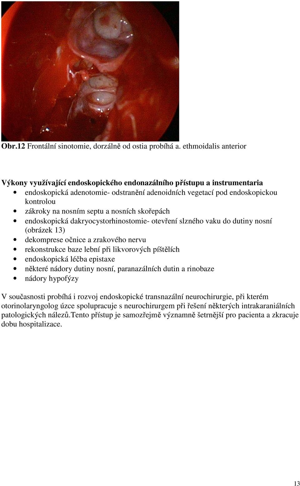 septu a nosních skořepách endoskopická dakryocystorhinostomie- otevření slzného vaku do dutiny nosní (obrázek 13) dekomprese očnice a zrakového nervu rekonstrukce baze lební při likvorových píštělích