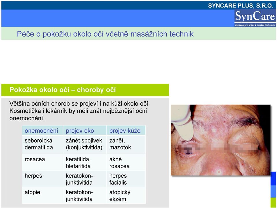 onemocnění projev oko projev kůže seboroická dermatitida zánět spojivek (konjuktivitida) zánět,