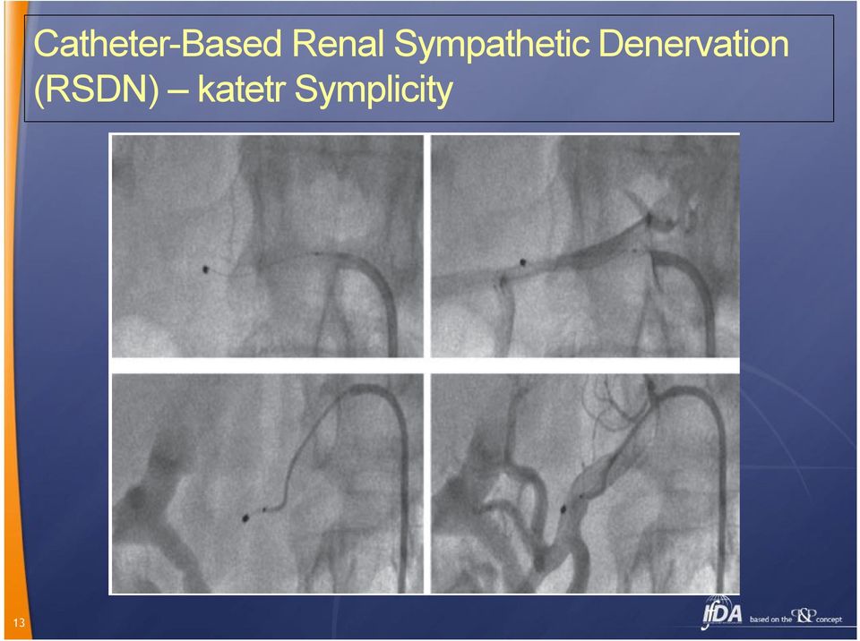 Denervation