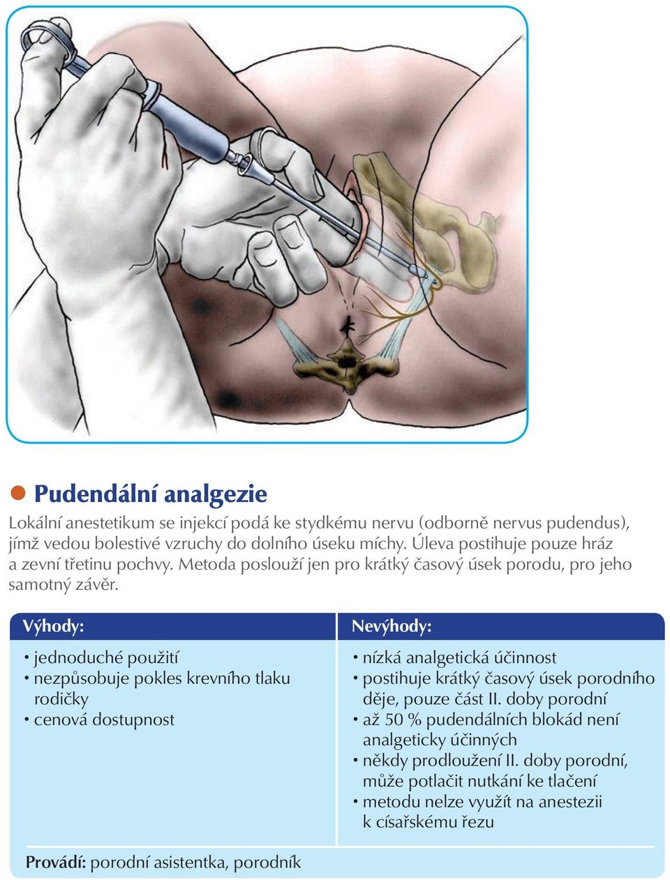 jednoduché použití nezpůsobuje pokles krevního tlaku rodičky cenová dostupnost nízká analgetická účinnost postihuje krátký časový úsek porodního děje, pouze část II.