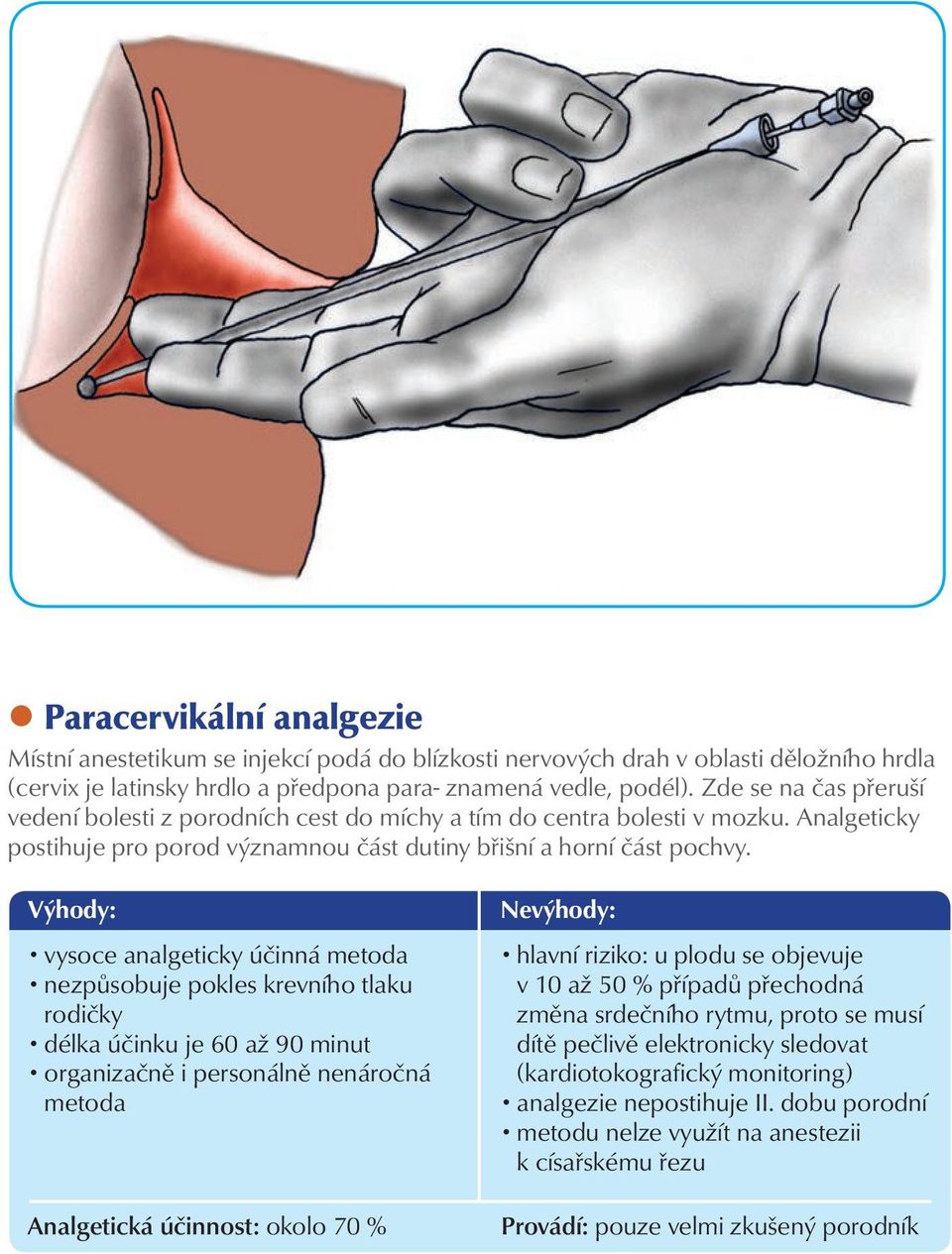 vysoce analgeticky účinná metoda nezpůsobuje pokles krevního tlaku rodičky délka účinku je 60 až 90 minut organizačně i personálně nenáročná metoda Analgetická účinnost: okolo 70 % hlavní riziko: u