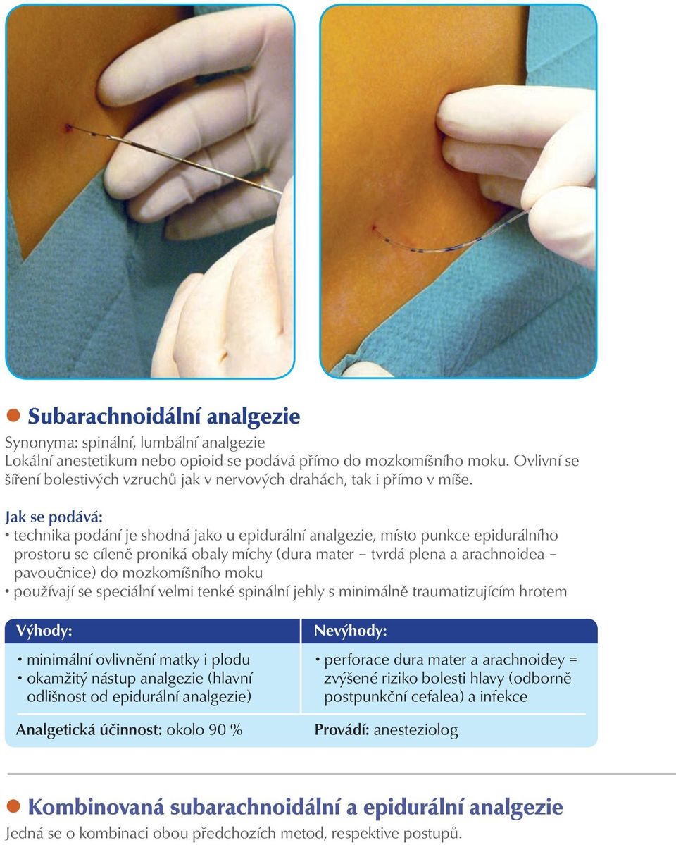 Jak se podává: technika podání je shodná jako u epidurální analgezie, místo punkce epidurálního prostoru se cíleně proniká obaly míchy (dura mater tvrdá plena a arachnoidea pavoučnice) do